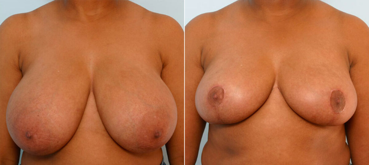 Breast Reduction before and after photos in Houston, TX, Patient 27678