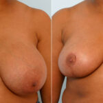 Breast Reduction before and after photos in Houston, TX, Patient 27678