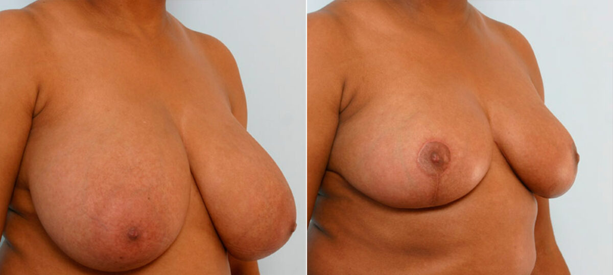 Breast Reduction before and after photos in Houston, TX, Patient 27678