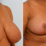 Breast Reduction before and after photos in Houston, TX, Patient 27678