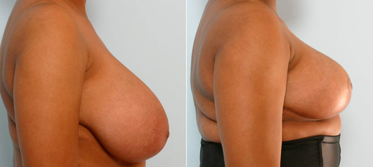 Breast Reduction before and after photos in Houston, TX, Patient 27678