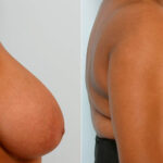 Breast Reduction before and after photos in Houston, TX, Patient 27678