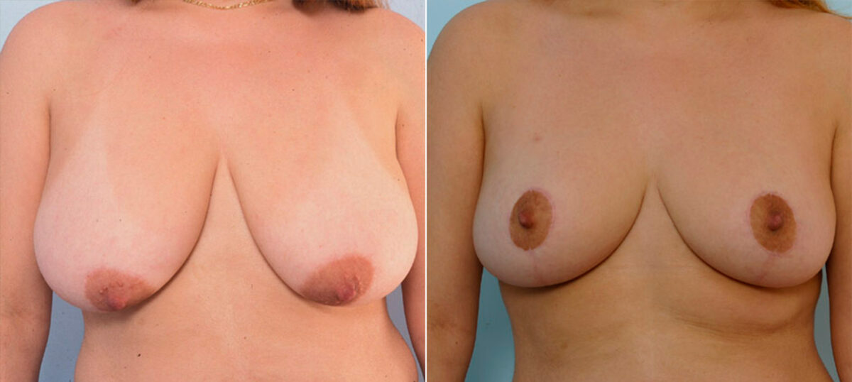 Breast Reduction before and after photos in Houston, TX, Patient 27685