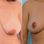Breast Reduction before and after photos in Houston, TX, Patient 27685