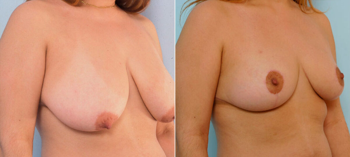 Breast Reduction before and after photos in Houston, TX, Patient 27685