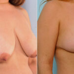 Breast Reduction before and after photos in Houston, TX, Patient 27685