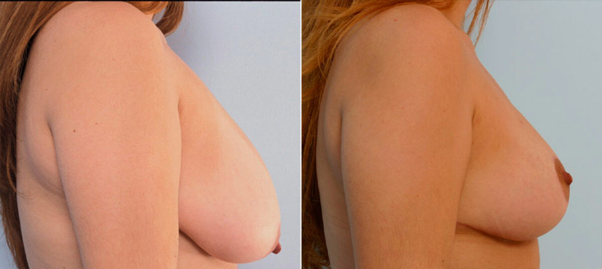 Breast Reduction before and after photos in Houston, TX, Patient 27685