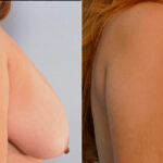 Breast Reduction before and after photos in Houston, TX, Patient 27685