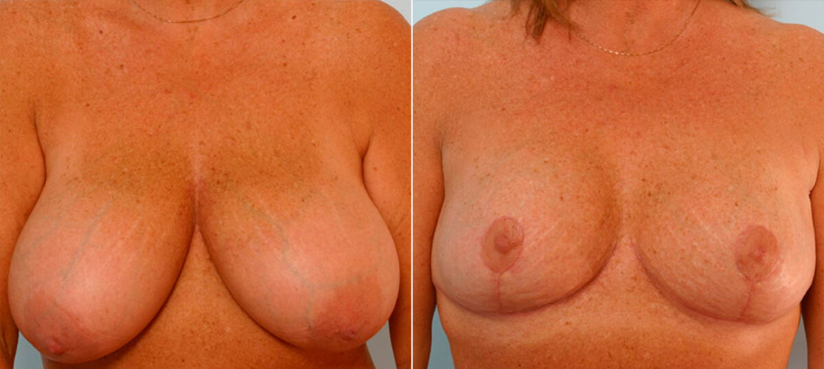 Breast Reduction before and after photos in Houston, TX, Patient 27692