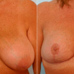 Breast Reduction before and after photos in Houston, TX, Patient 27692