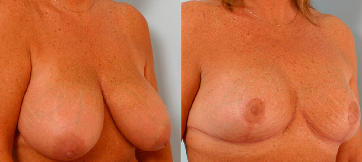 Breast Reduction before and after photos in Houston, TX, Patient 27692