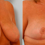 Breast Reduction before and after photos in Houston, TX, Patient 27692