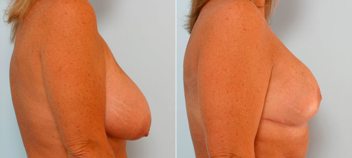 Breast Reduction before and after photos in Houston, TX, Patient 27692