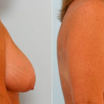 Breast Reduction before and after photos in Houston, TX, Patient 27692