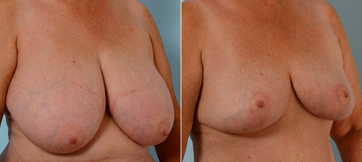 Breast Reduction before and after photos in Houston, TX, Patient 27699