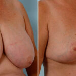 Breast Reduction before and after photos in Houston, TX, Patient 27699