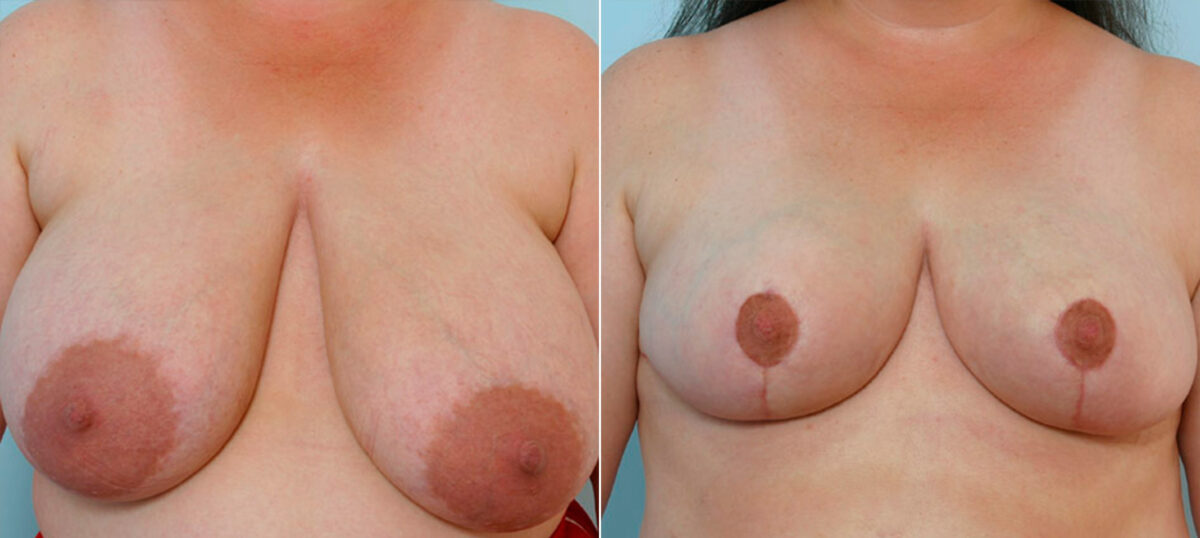 Breast Reduction before and after photos in Houston, TX, Patient 27706