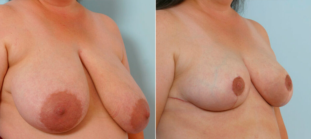 Breast Reduction before and after photos in Houston, TX, Patient 27706