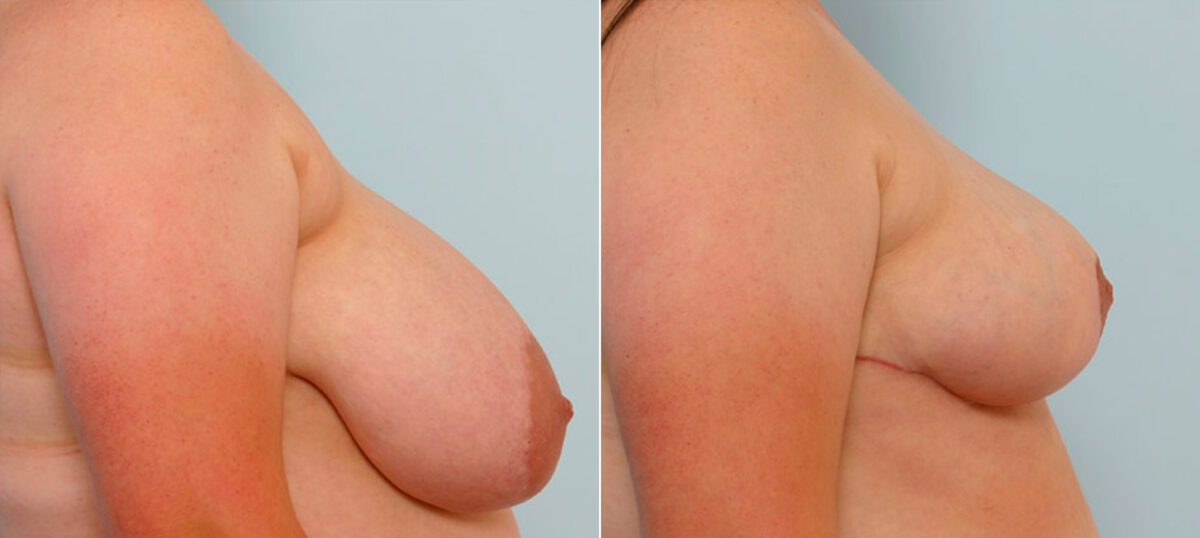 Breast Reduction before and after photos in Houston, TX, Patient 27706