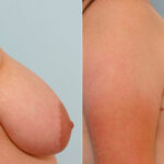 Breast Reduction before and after photos in Houston, TX, Patient 27706