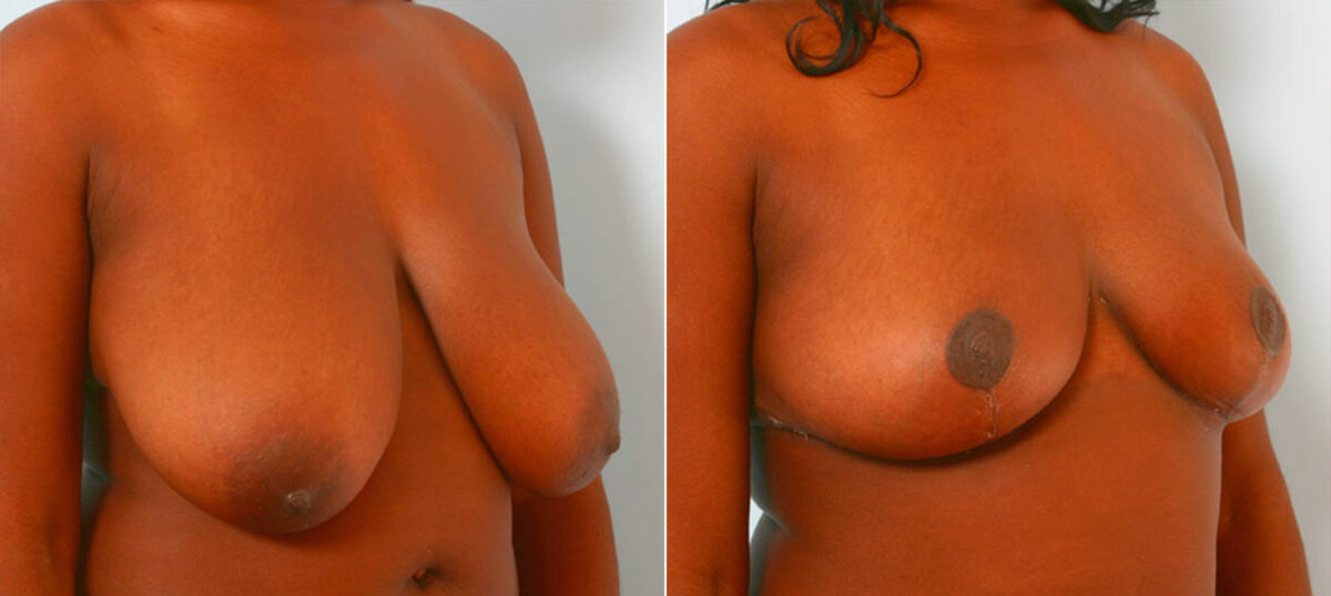 Breast Reduction before and after photos in Houston, TX, Patient 27713