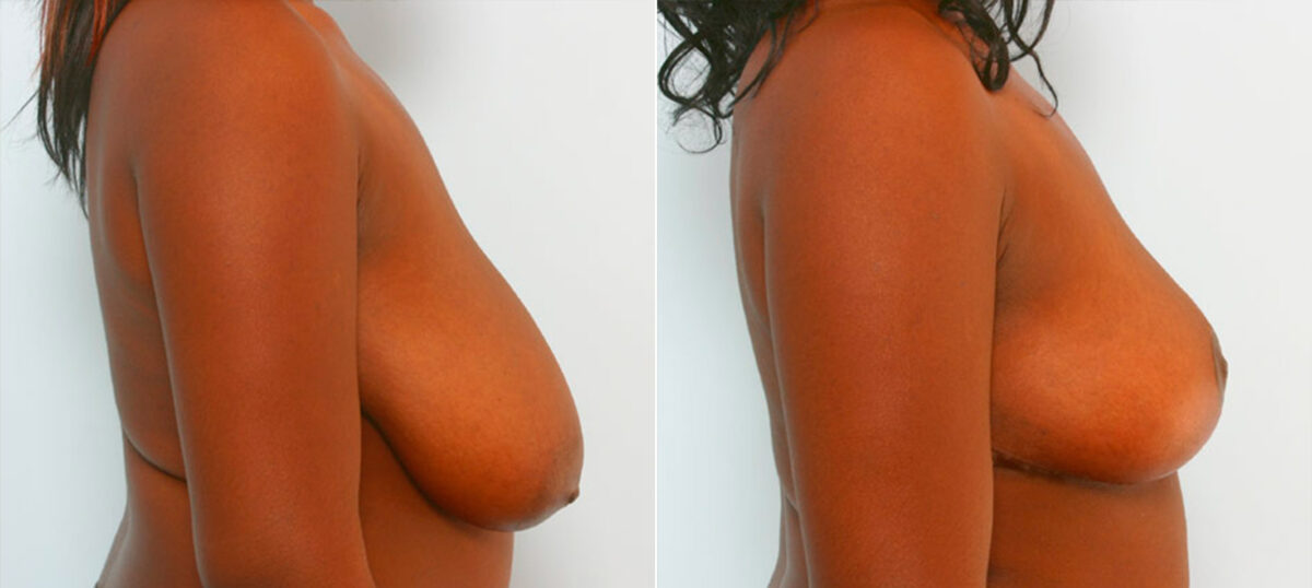 Breast Reduction before and after photos in Houston, TX, Patient 27713