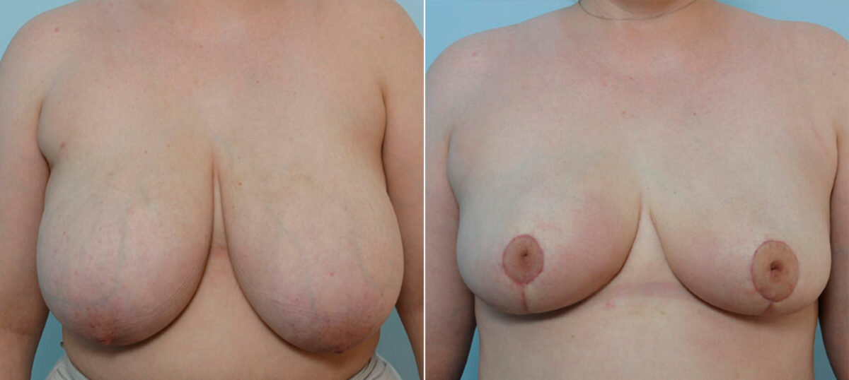 Breast Reduction before and after photos in Houston, TX, Patient 27718