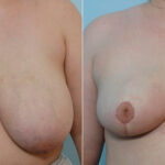 Breast Reduction before and after photos in Houston, TX, Patient 27718