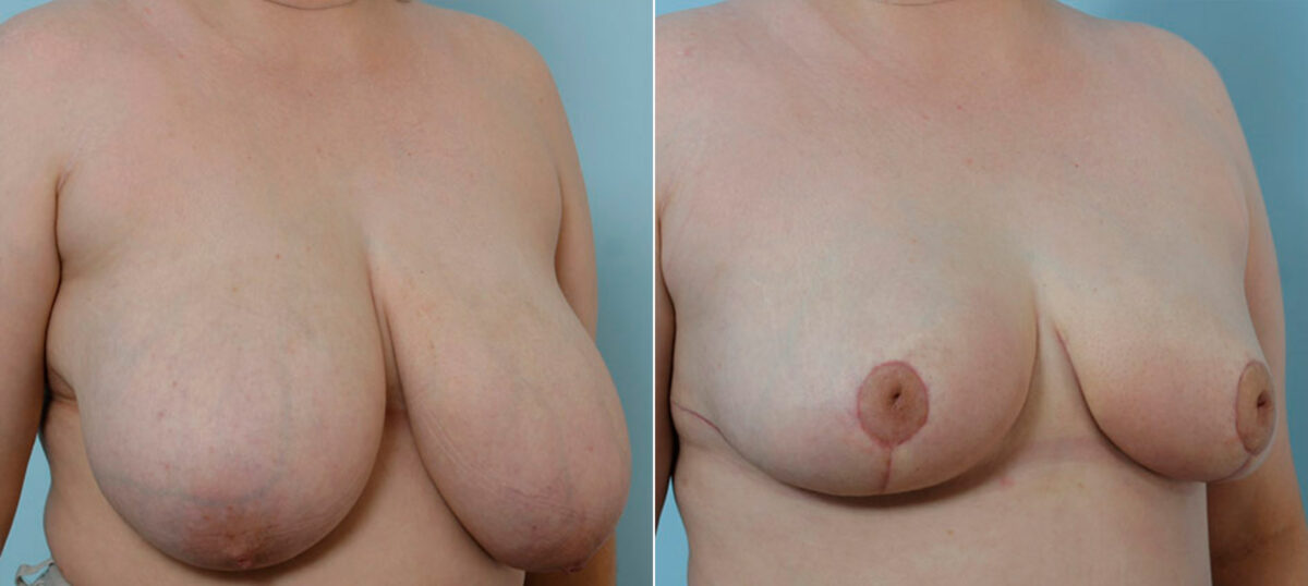 Breast Reduction before and after photos in Houston, TX, Patient 27718