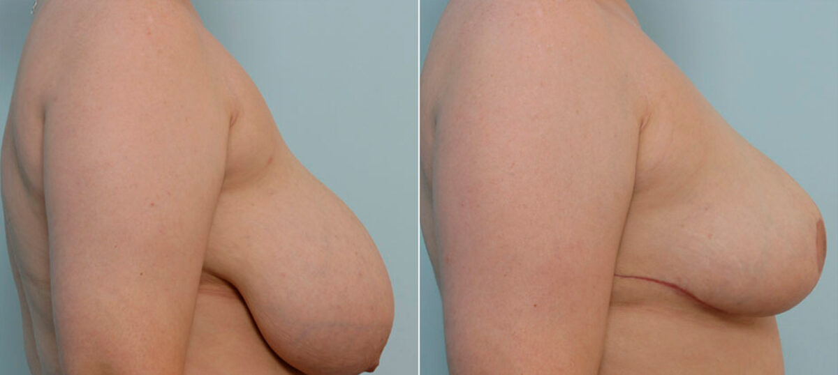 Breast Reduction before and after photos in Houston, TX, Patient 27718