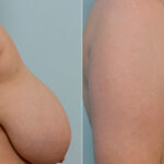 Breast Reduction before and after photos in Houston, TX, Patient 27718