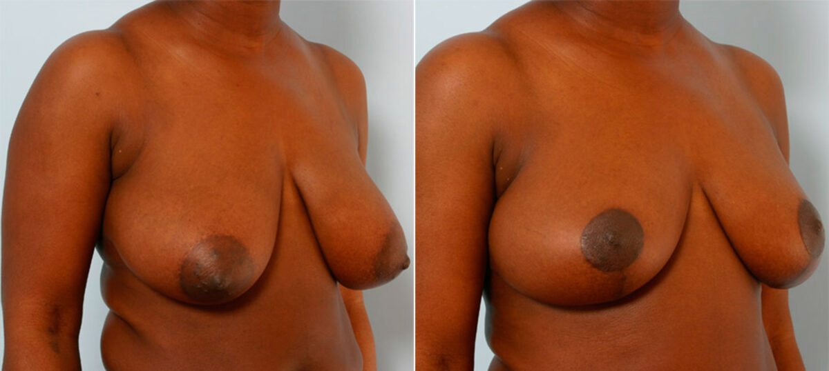 Breast Reduction before and after photos in Houston, TX, Patient 27725