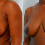 Breast Reduction before and after photos in Houston, TX, Patient 27725