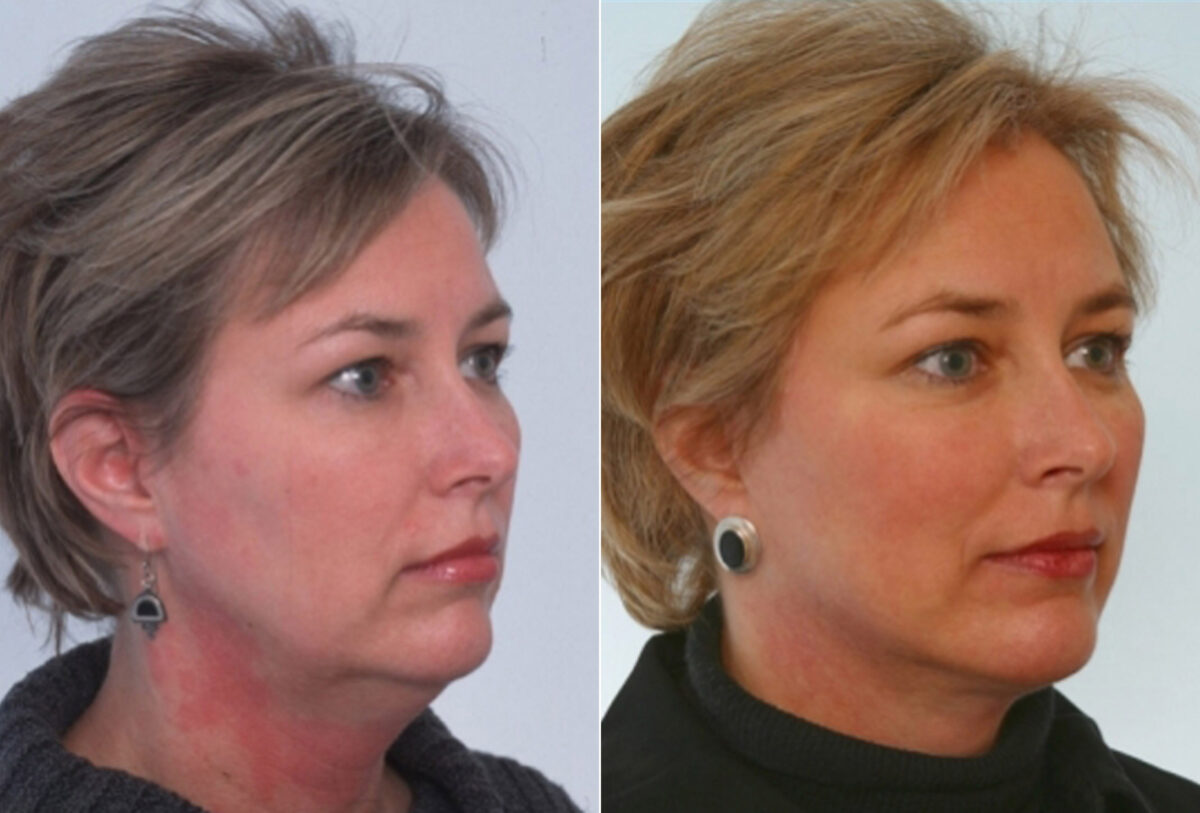 Facelift before and after photos in Houston, TX, Patient 28348