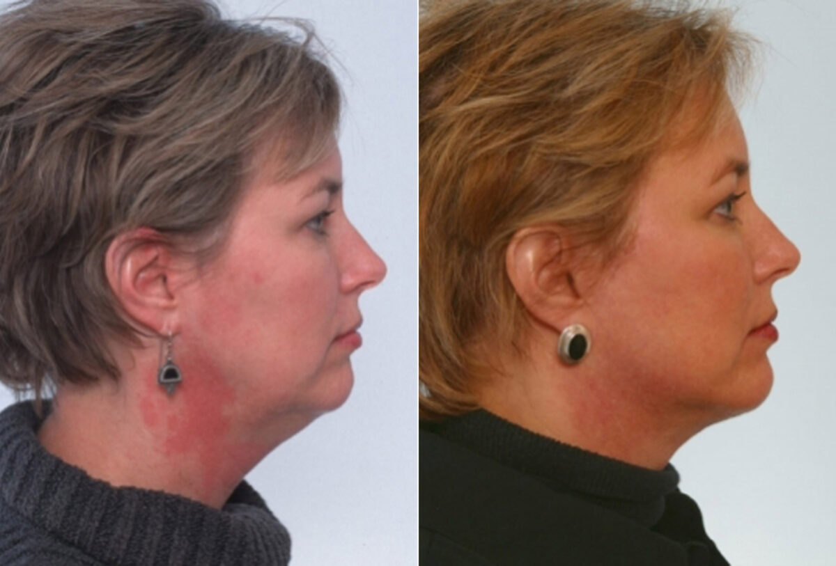 Facelift before and after photos in Houston, TX, Patient 28348