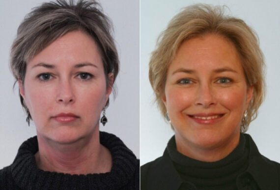 Facelift before and after photos in Houston, TX, Patient 28348