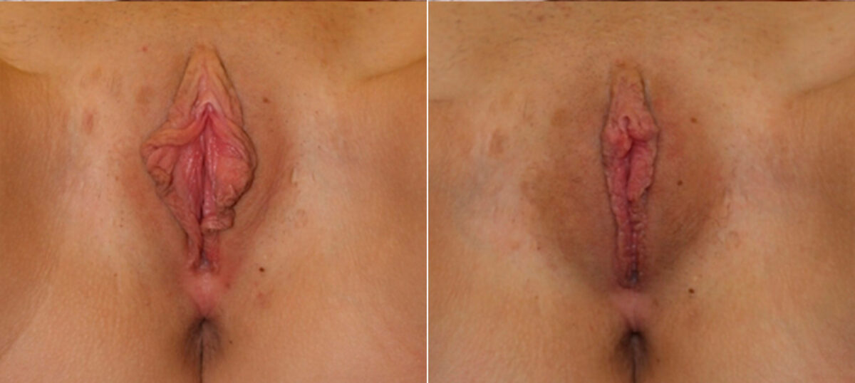 Labiaplasty before and after photos in Houston, TX, Patient 28739