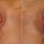 Labiaplasty before and after photos in Houston, TX, Patient 28739