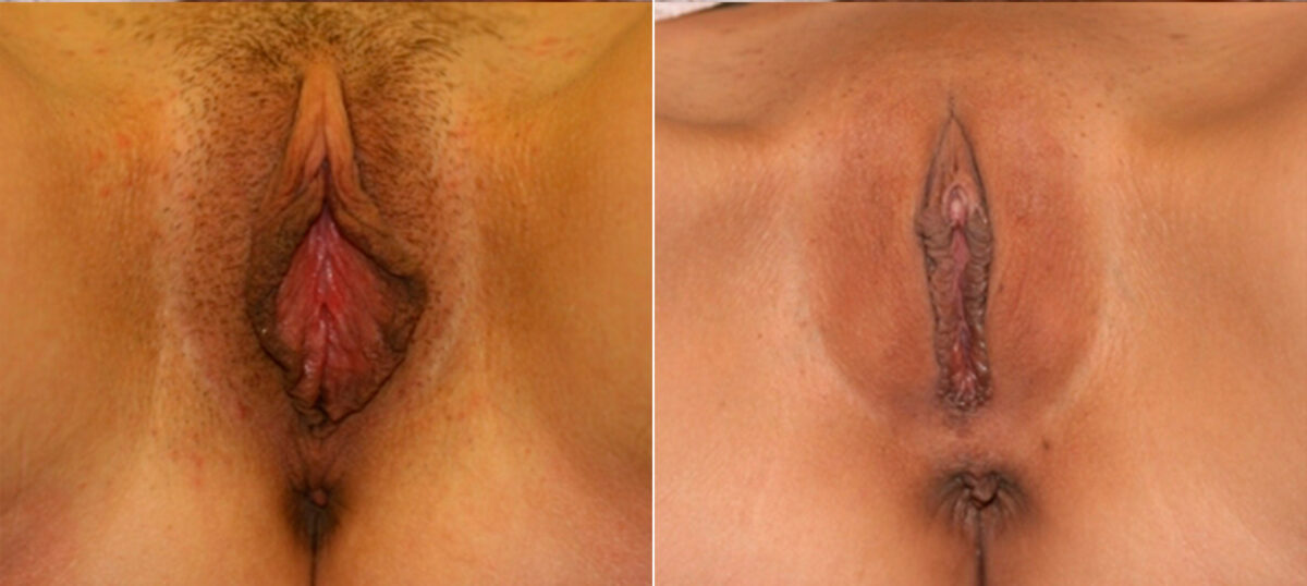 Labiaplasty before and after photos in Houston, TX, Patient 28742