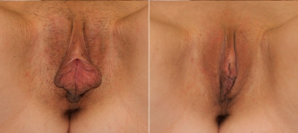 Labiaplasty before and after photos in Houston, TX, Patient 28745
