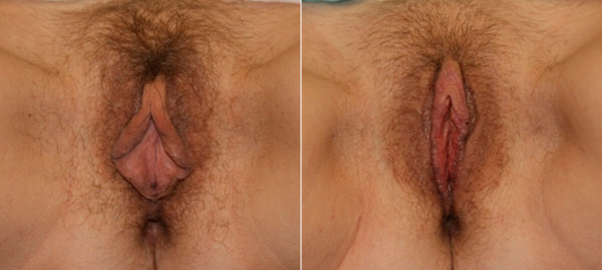 Labiaplasty before and after photos in Houston, TX, Patient 28760