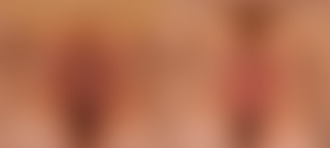 Labiaplasty before and after photos in Houston, TX, Patient 28763