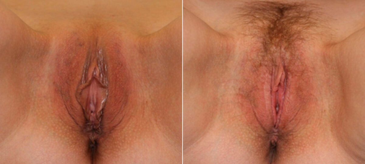 Labiaplasty before and after photos in Houston, TX, Patient 28763