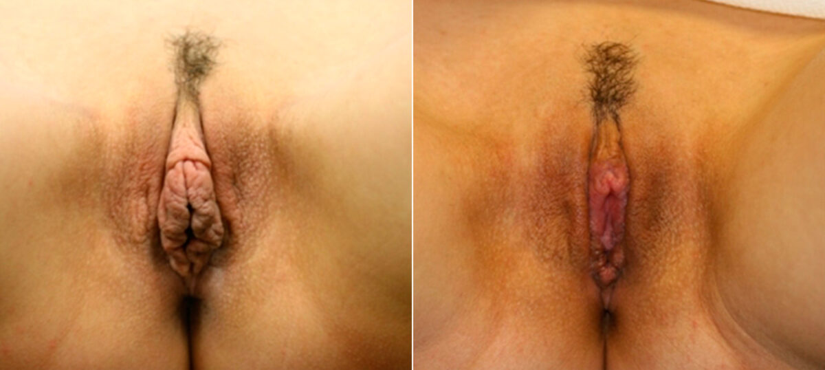 Labiaplasty before and after photos in Houston, TX, Patient 28772