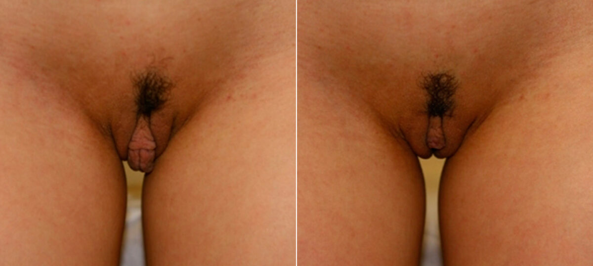 Labiaplasty before and after photos in Houston, TX, Patient 28772