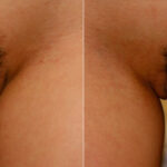 Labiaplasty before and after photos in Houston, TX, Patient 28772