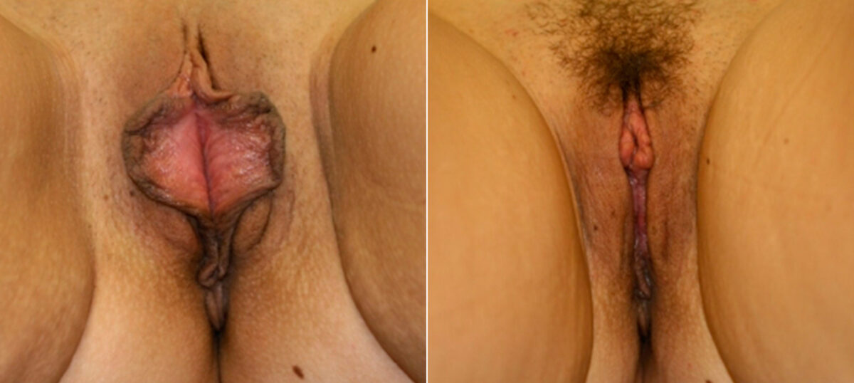 Labiaplasty before and after photos in Houston, TX, Patient 28779