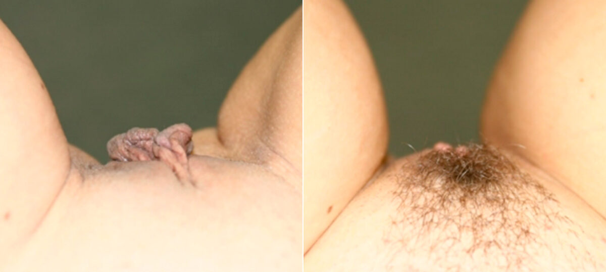 Labiaplasty before and after photos in Houston, TX, Patient 28779