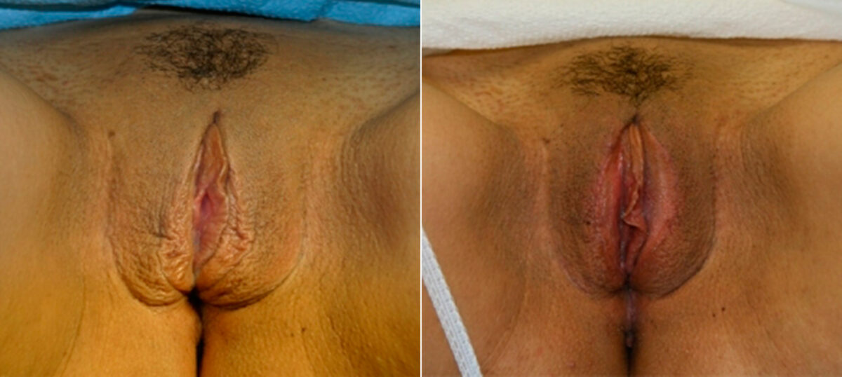 Labiaplasty before and after photos in Houston, TX, Patient 28793
