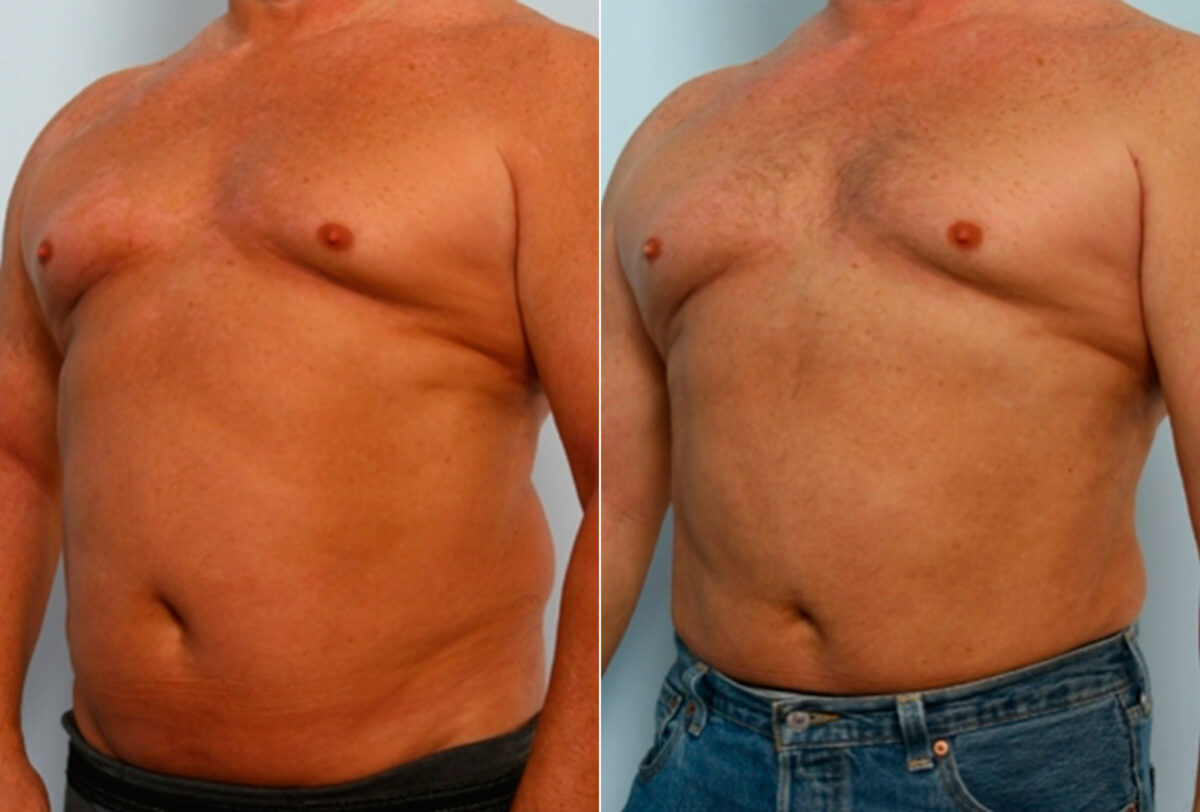 Male Liposuction before and after photos in Houston, TX, Patient 28894